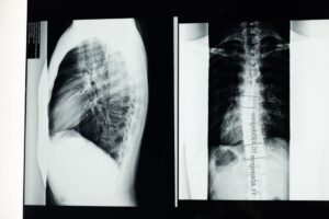 disc disease